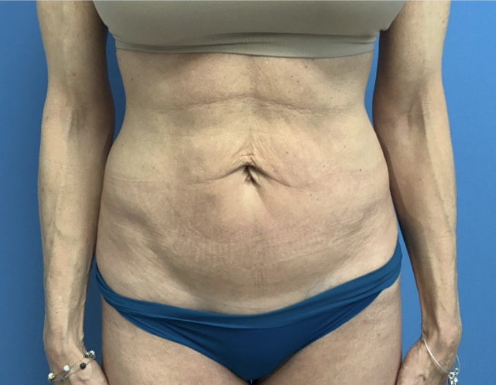 Tummy-Tuck--Case-Study-2907 | Before Body